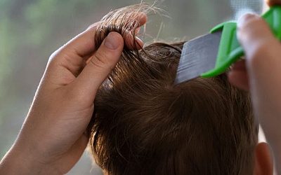 «Это необычно»: в столице Литвы зафиксировали аномальную вспышку педикулёза